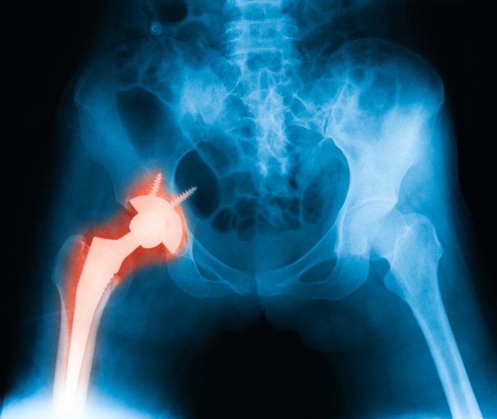 x-ray of a hip with a screw in it