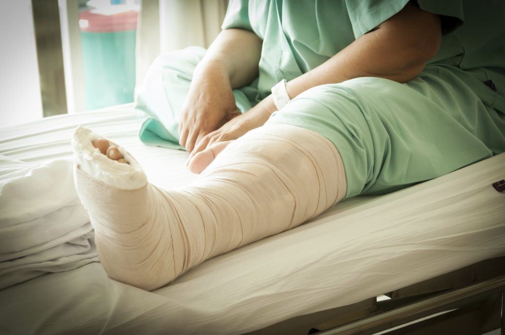 Patient with a Cast on Left Leg