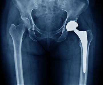 Hip Replacement Xray